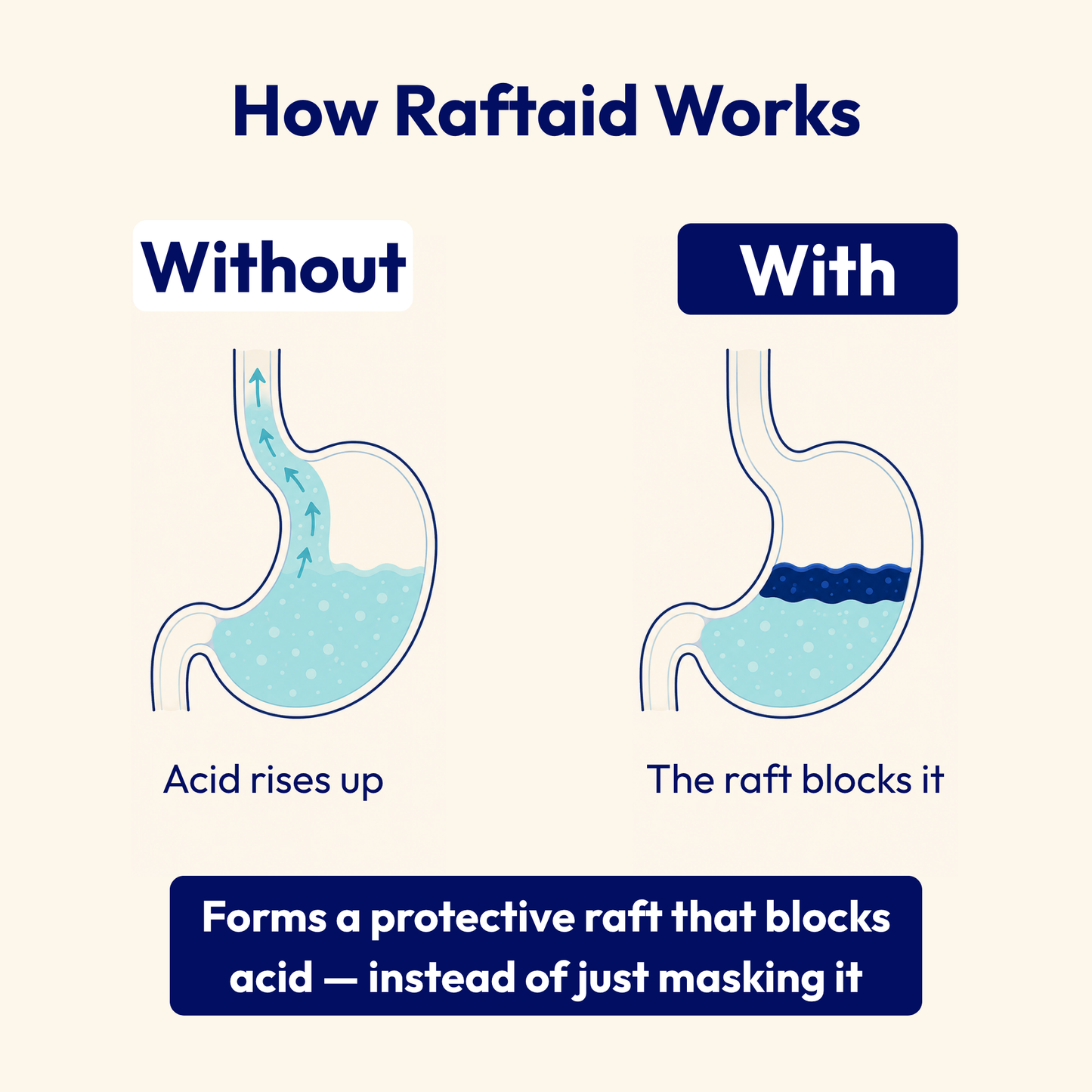 Raftaid™ Alginate Reflux Support